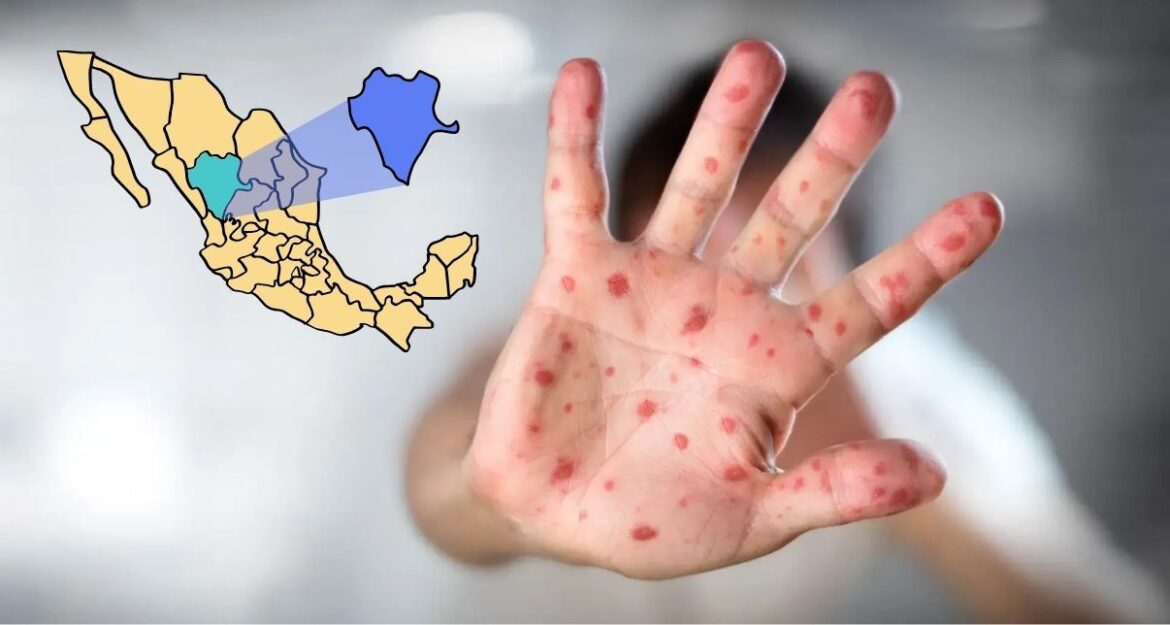 Reportan 185 casos de sarampión en Durango con mayor incidencia en niños y región capital