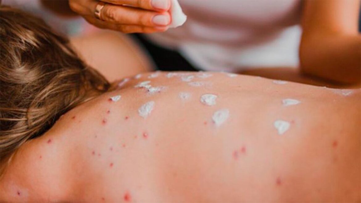 México registra 14 mil casos de sarampión y primer fallecimiento por miasis