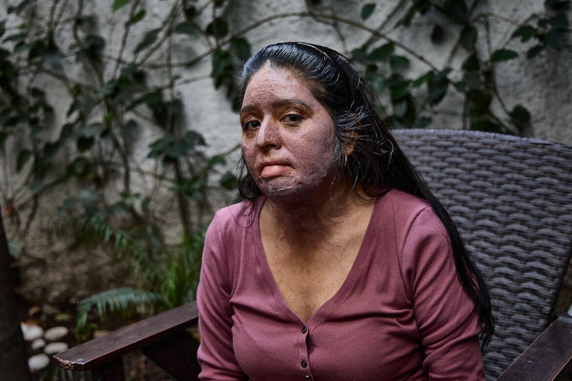 Carmela Juárez recibe tratamientos gratuitos tras sobrevivir a ataque con gasolina en Oaxaca