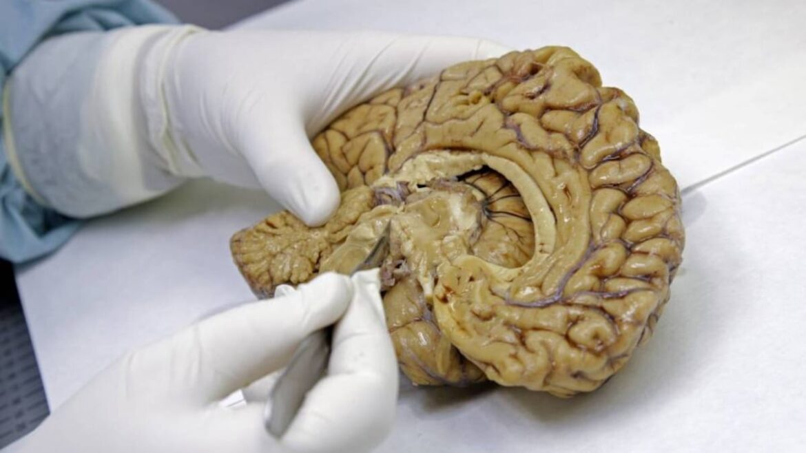 Estudios detectan biomarcadores de Alzheimer en sangre hasta 10 años antes de síntomas